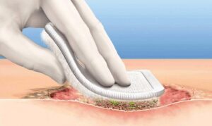 desbridamento de feridas - WK Cursos e Saúde